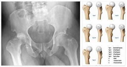 Femoral Head Fracture